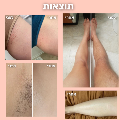 מכונת הלייזר של LUNERE